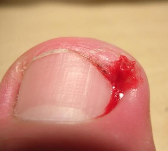 how to cure ingrown nail