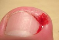 Ingrown nail treatment at home possible?