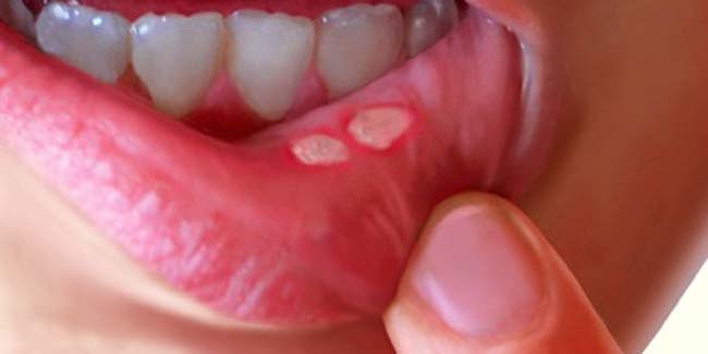 a Canker sore on the gums of the child