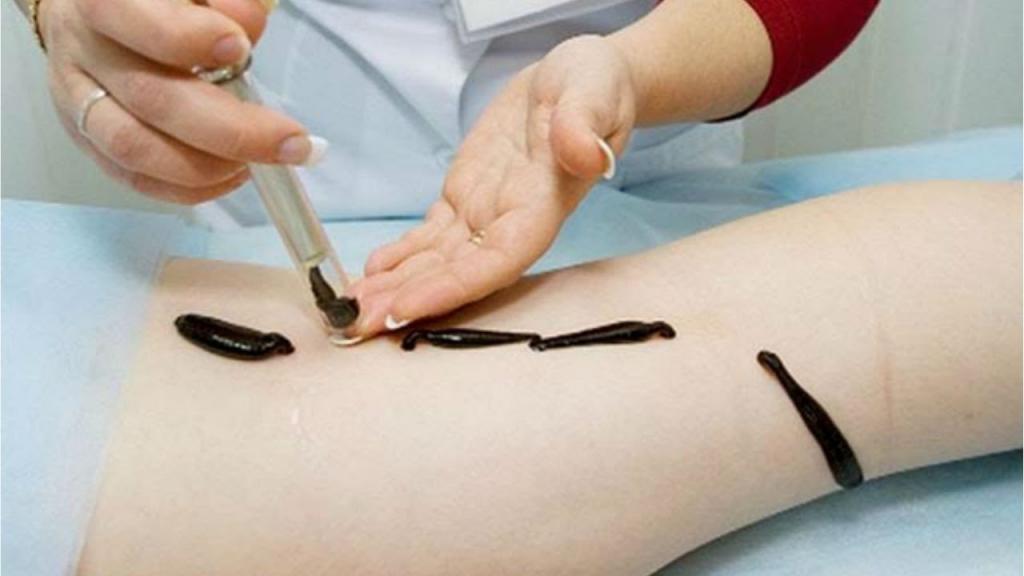 treatment of varicose veins on the legs with leeches