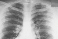 Щеплення від туберкульозу. Що потрібно знати?