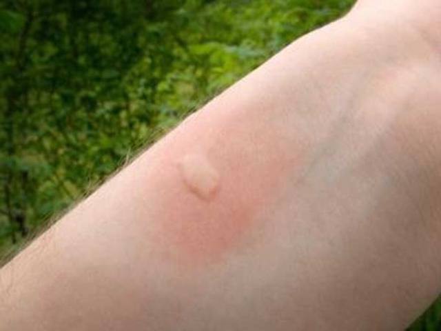 how to protect yourself from mosquitoes