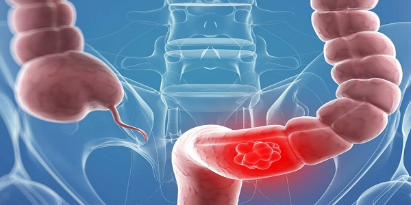 First signs of colon cancer
