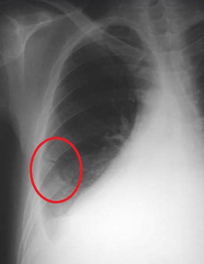 how to heal a rib fracture without displacement