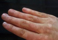 El vitiligo es lo que es? Causas, síntomas y tratamiento para el vitiligo