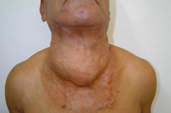 nodular sclerosis Hodgkin's lymphoma