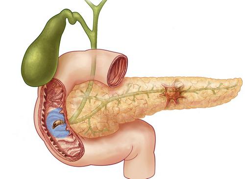 doença do pâncreas tratamento