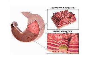 la gastritis erosiva el código de la cie-10