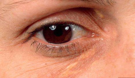 gelb um die Augen-Ursachen und Behandlung