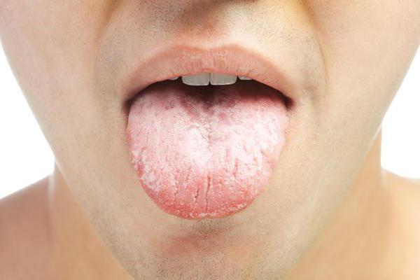 Geschwollene Zunge: Ursachen