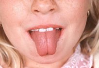 Swollen tongue: causes and consequences