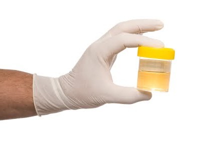 尿検査の集め方