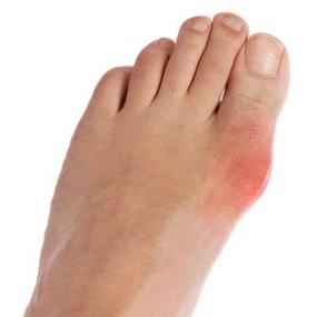 diet for gout on feet
