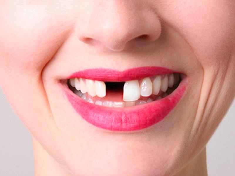 До чого сниться, що випало багато зубів без крові?