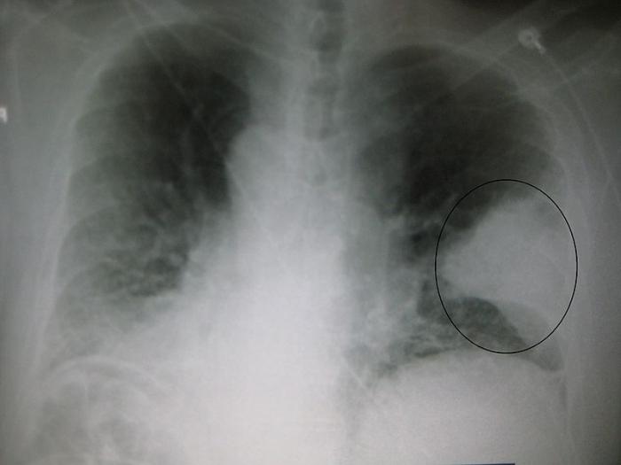 zapalenie płuc etiologia