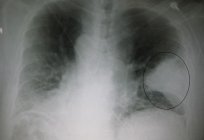 Zapalenie płuc - co to jest?