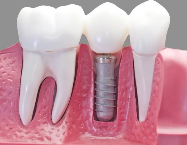 dental implant city reviews