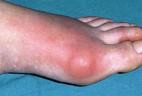 how to treat gout on feet