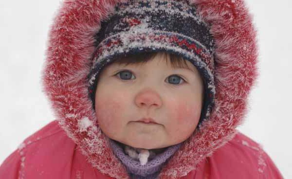 cold dermatitis in a child