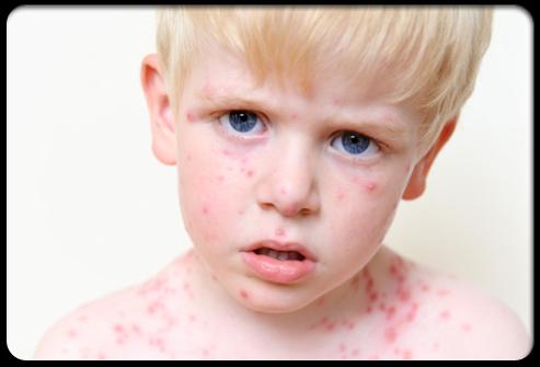 shingles in a child on the face