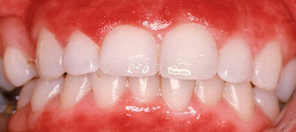 歯槽膿漏症状