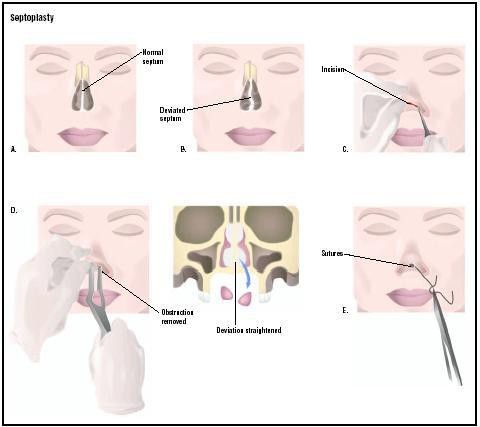 transferência de correcção nasal divisória laser