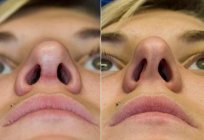 The operation to correct the nasal septum: methods and reviews