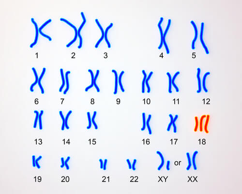 Edwards syndrome karyotype