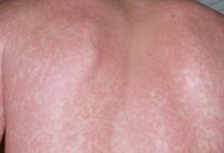 Spots on body: causes, prevention, treatment