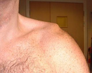 luxación de hombro síntomas de la enfermedad de la prevención y el tratamiento