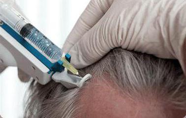 la mesoterapia en el cuero cabelludo