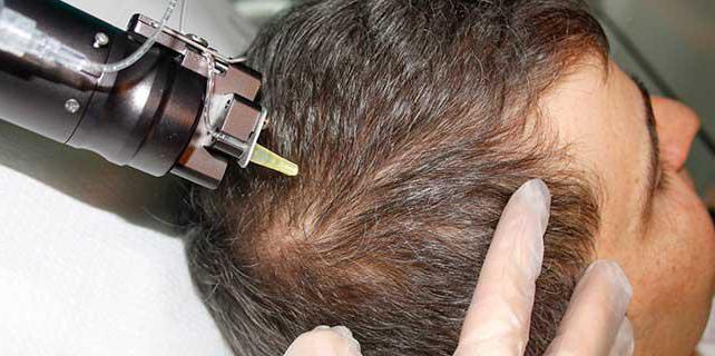 ułamkowe mezoterapia owłosionej skóry głowy