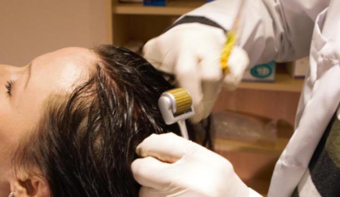 die Technik der Mesotherapie der Kopfhaut