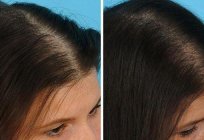 Mesotherapy scalp: reviews