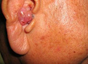 रोगों के बाहरी कान