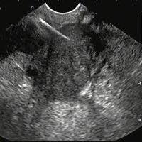 Ultraschalluntersuchung der Prostata