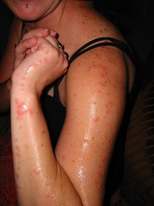 Allergy to mosquito bites