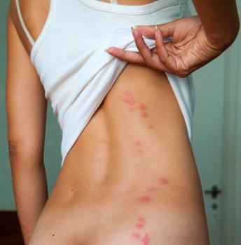 алергія на комарині укуси фото