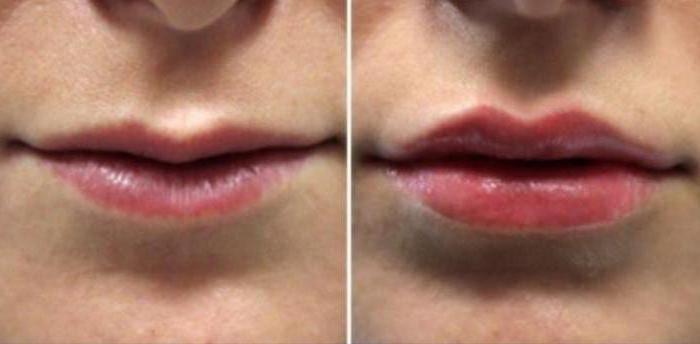 the shape of the lips with hyaluronic acid