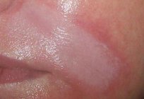 玻尿酸的嘴唇评论，之前和之后的照片