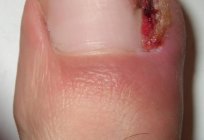 Las uñas de los pies echan: métodos de tratamiento