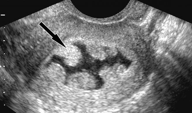 Polyps in uterus symptoms
