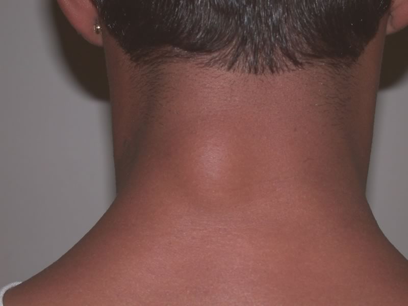 lipoma on the neck