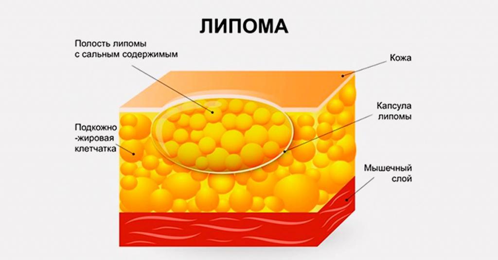 the structure of lipoma