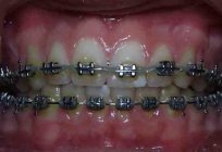 Metal braces will make your smile perfect!