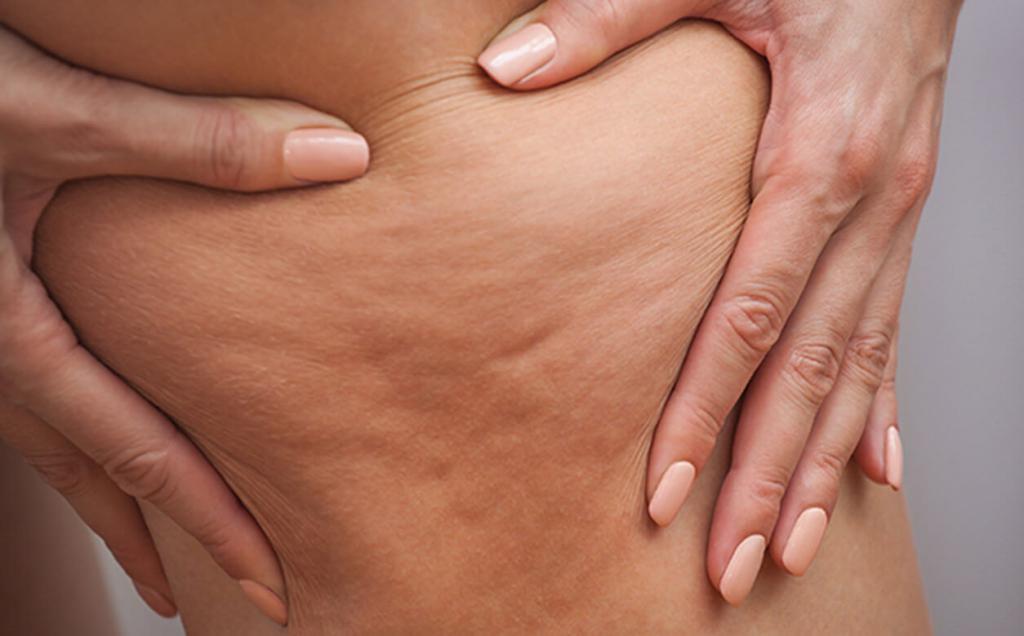 the Visual appearance of cellulite