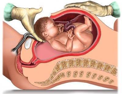ندبة الرحم الحمل