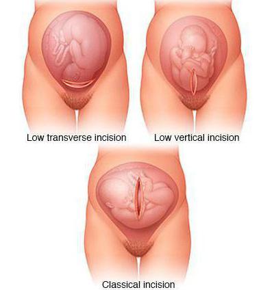 uterine scar after cesarean section