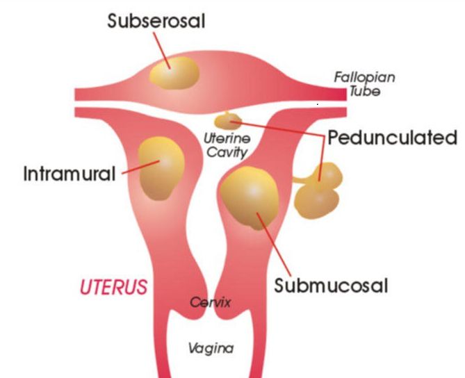 la миоме uterino en el embarazo