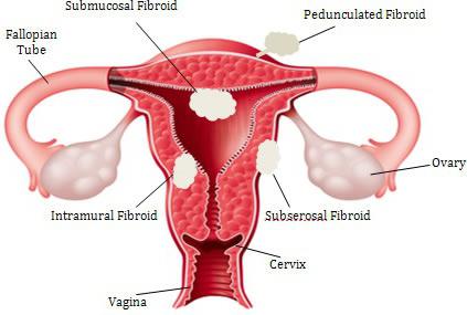 possible pregnancy with uterine fibroids